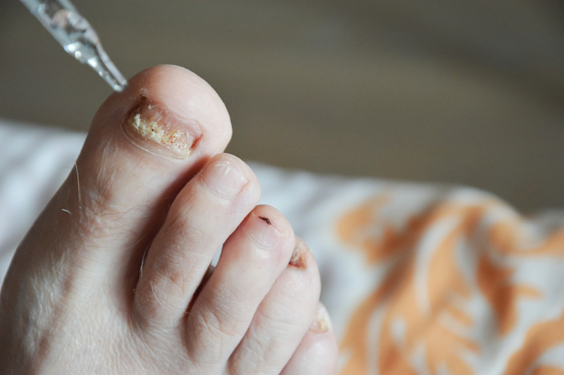 Ingrown Toenail Treatment & Care In Jacksonville FL